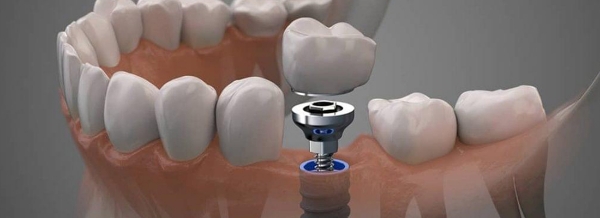 انواع روش های ایمپلنت | تکنا 12 اندوستیال