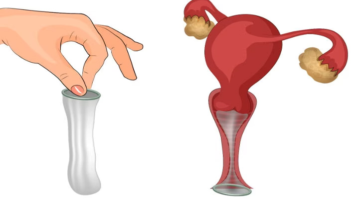 کاندوم زنانه؛ انواع، مزایا، معایب و روش استفاده_مجله رشد 7 نحوه استفاده از کاندوم زنانه