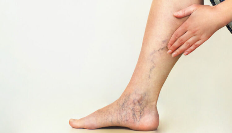 نشانه بیماری عروق خونی در ساق پا