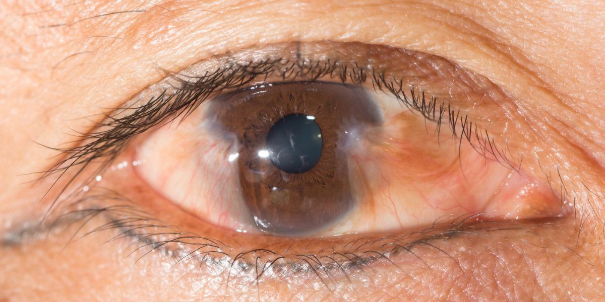 چربی داخل چشم