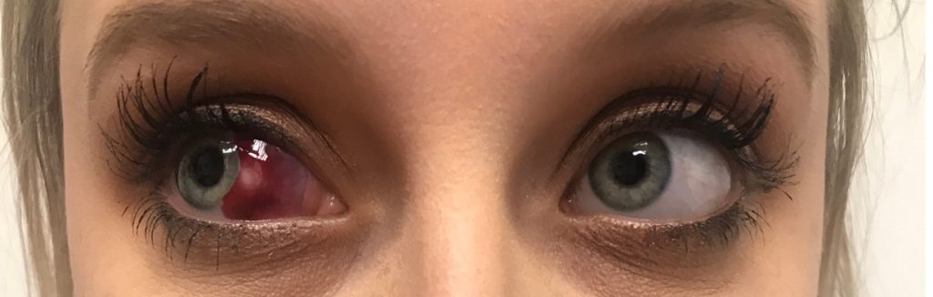 چربی داخل چشم پینگوکولا